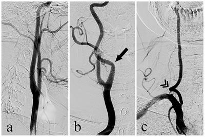 Association between kinking of the cervical carotid or vertebral artery and ischemic stroke/TIA